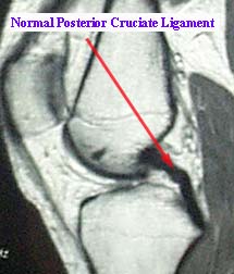 Normal Posterior Cruciate Ligament